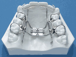 Orthodontic Expanders - West Des Moines- Family Orthodontics IA